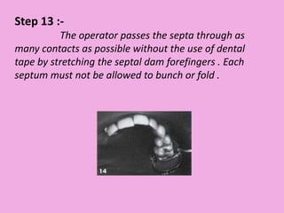Step 13 :-
The operator passes the septa through as
many contacts as possible without the use of dental
tape by stretching the septal dam forefingers . Each
septum must not be allowed to bunch or fold .
 