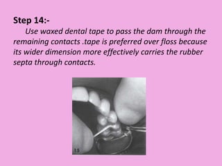 Step 14:-
Use waxed dental tape to pass the dam through the
remaining contacts .tape is preferred over floss because
its wider dimension more effectively carries the rubber
septa through contacts.
 