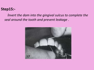 Step15:-
Invert the dam into the gingival sulcus to complete the
seal around the tooth and prevent leakage .
 