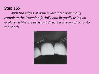 Step 16:-
With the edges of dam invert inter proximally,
complete the inversion facially and lingually using an
explorer while the assistant directs a stream of air onto
the tooth.
 
