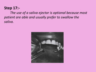 Step 17:-
The use of a saliva ejector is optional because most
patient are able and usually prefer to swallow the
saliva.
 