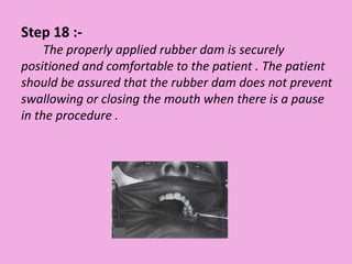 Step 18 :-
The properly applied rubber dam is securely
positioned and comfortable to the patient . The patient
should be assured that the rubber dam does not prevent
swallowing or closing the mouth when there is a pause
in the procedure .
 