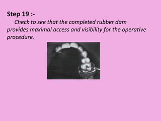 Step 19 :-
Check to see that the completed rubber dam
provides maximal access and visibility for the operative
procedure.
 