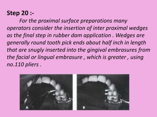 Step 20 :-
For the proximal surface preparations many
operators consider the insertion of inter proximal wedges
as the final step in rubber dam application . Wedges are
generally round tooth pick ends about half inch in length
that are snugly inserted into the gingival embrasures from
the facial or lingual embrasure , which is greater , using
no.110 pliers .
 