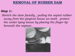 REMOVAL OF RUBBER DAM
Step 1:-
Stretch the dam facially , pulling the septal rubber
away from the gingival tissue an tooth .protect
the under lying tissue by placing the finger tip
beneath the septum .
 