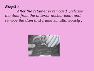 Step3 :-
After the retainer is removed ,release
the dam from the anterior anchor tooth and
remove the dam and frame simultaneously .
 