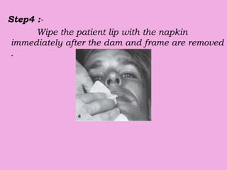 Step4 :-
Wipe the patient lip with the napkin
immediately after the dam and frame are removed
.
 