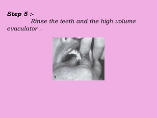 Step 5 :-
Rinse the teeth and the high volume
evaculator .
 