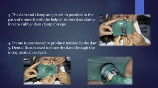 3. The dam and clamp are placed in position in the
patient’s mouth with the help of rubber dam clamp
forceps rubber dam clamp forceps
4. Frame is positioned to produce tension in the dam
5. Dental floss is used to force the dam through the
interproximal contacts.
 