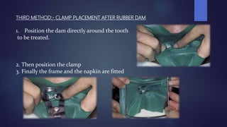 THIRD METHOD:- CLAMP PLACEMENT AFTER RUBBER DAM
1. Position the dam directly around the tooth
to be treated.
2. Then position the clamp
3. Finally the frame and the napkin are fitted
 