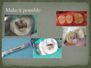Pickard’s manual of Operative Dentistry
Internet
 