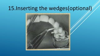 CLAMP FIRST TECHNIQUE
Advantages:
 It is two handed procedureore
 It can be implemented with molar and premolar(single b...