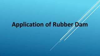 Application of Rubber Dam
 