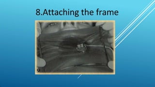 8.Attaching the frame
 