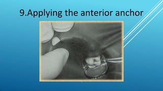 9.Applying the anterior anchor
 