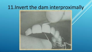 11.Invert the dam interproximally
 