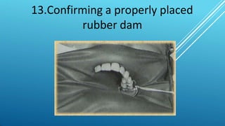 13.Confirming a properly placed
rubber dam
 