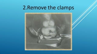 2.Remove the clamps
 