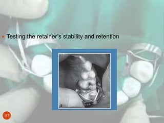 117
 Testing the retainer’s stability and retention
 