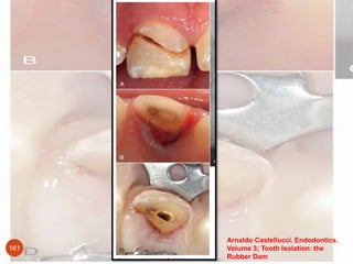 Arnaldo Castellucci. Endodontics.
Volume 3; Tooth Isolation: the
Rubber Dam
161
 
