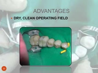 ADVANTAGES
23
 DRY, CLEAN OPERATING FIELD
 