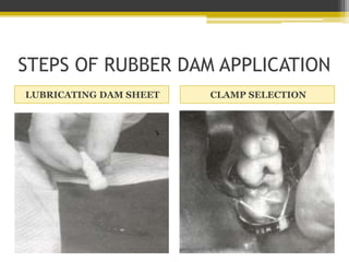 STEPS OF RUBBER DAM APPLICATION
POSITIONING THE DAM OVER THE CLAMP
 
