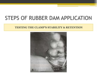 STEPS OF RUBBER DAM APPLICATION
APPLYING THE NAPKIN
 