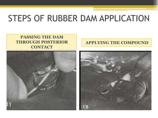 STEPS OF RUBBER DAM APPLICATION
PASSING THE SEPTA THROUGH THE CONTACTS WITH TAPE
 