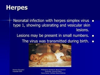 Phlebotomy Handbook: Blood Collection
Essentials, Seventh Edition
Diana Garza • Kathleen Becan-McBride
Pearson Education
Copyright 2005
Herpes
Neonatal infection with herpes simplex virus
type 1, showing ulcerating and vesicular skin
lesions.
Lesions may be present in small numbers.
The virus was transmitted during birth.
 