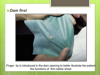 Dam first
Finger tip is introduced in the dam opening to better illustrate the patient
the functions of this rubber sheet
 