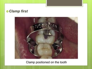 Clamp first
Clamp positioned on the tooth
 