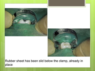 Rubber sheet has been slid below the clamp, already in
place
 