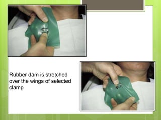 Rubber dam is stretched
over the wings of selected
clamp
 