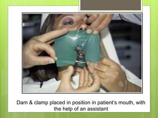 Dam & clamp placed in position in patient’s mouth, with
the help of an assistant
 