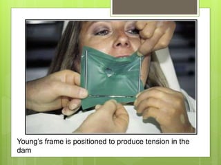 Young’s frame is positioned to produce tension in the
dam
 