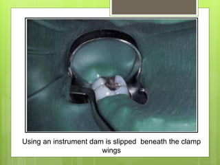 Using an instrument dam is slipped beneath the clamp
wings
 