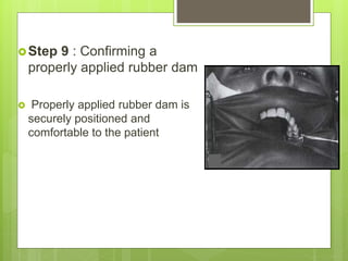 Step 9 : Confirming a
properly applied rubber dam
 Properly applied rubber dam is
securely positioned and
comfortable to the patient
 
