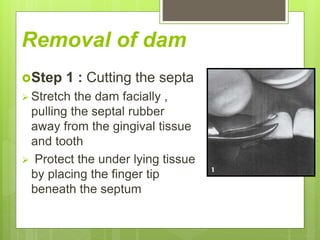 Removal of dam
Step 1 : Cutting the septa
 Stretch the dam facially ,
pulling the septal rubber
away from the gingival tissue
and tooth
 Protect the under lying tissue
by placing the finger tip
beneath the septum
 