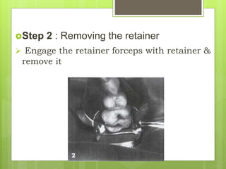 Step 2 : Removing the retainer
 Engage the retainer forceps with retainer &
remove it
 
