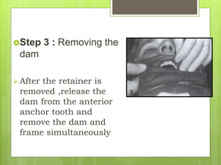 Step 3 : Removing the
dam
 After the retainer is
removed ,release the
dam from the anterior
anchor tooth and
remove the dam and
frame simultaneously
 