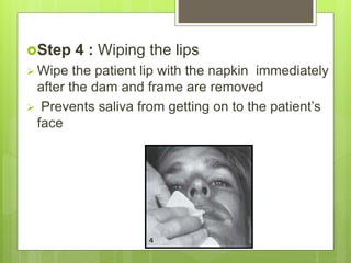 Step 4 : Wiping the lips
 Wipe the patient lip with the napkin immediately
after the dam and frame are removed
 Prevents saliva from getting on to the patient’s
face
 