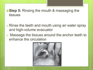 Step 5: Rinsing the mouth & massaging the
tissues
 Rinse the teeth and mouth using air water spray
and high-volume evacuator
 Massage the tissues around the anchor teeth to
enhance the circulation
 