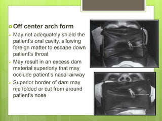 Off center arch form
 May not adequately shield the
patient’s oral cavity, allowing
foreign matter to escape down
patient’s throat
 May result in an excess dam
material superiorly that may
occlude patient’s nasal airway
 Superior border of dam may
me folded or cut from around
patient’s nose
 