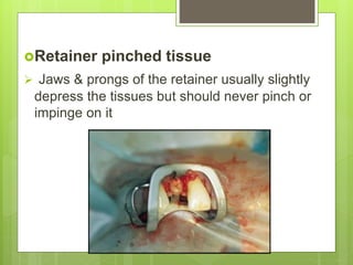 Retainer pinched tissue
 Jaws & prongs of the retainer usually slightly
depress the tissues but should never pinch or
impinge on it
 
