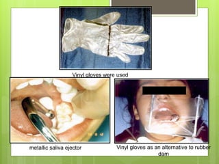 Vinyl gloves were used
Vinyl gloves as an alternative to rubber
dam
metallic saliva ejector
 
