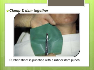 Dam & clamp placed in position in patient’s mouth, with
the help of an assistant
 