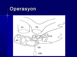 PAAo
AR
VSD
PV LCA
VSI
OperasyonOperasyon
 