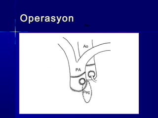 Ao
PA
Peç
OperasyonOperasyon
Ao
 