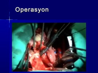 OperasyonOperasyon
 