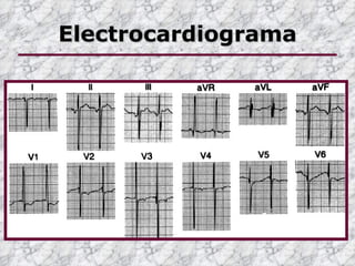 Electrocardiograma
 